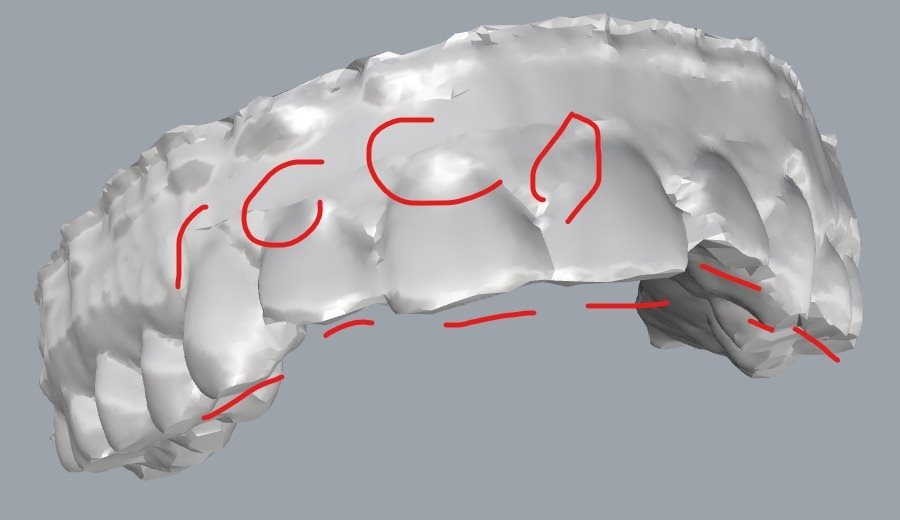 Front view of the same mold scan with the gum line marked in red