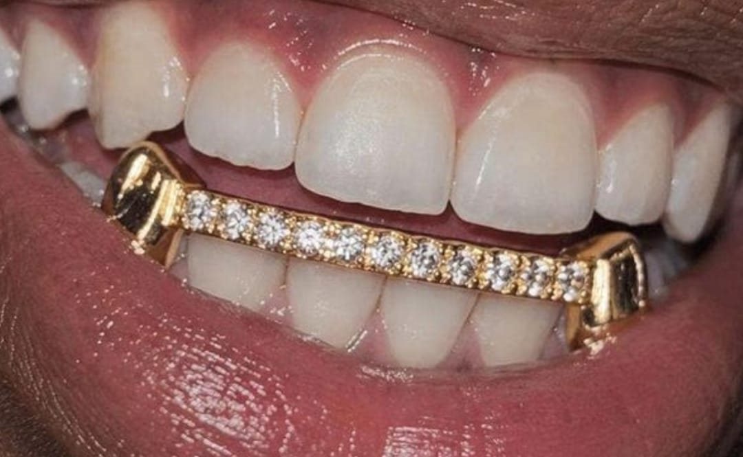 Design concept: gold bar set with a row of diamonds across six bottom teeth
